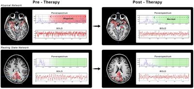 Pre- and post-therapy functional MRI connectivity in severe acute brain injury with suppression of consciousness: a comparative analysis to epilepsy features